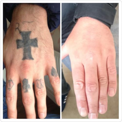 The Missing Ink Laser Tattoo Removal Stockport